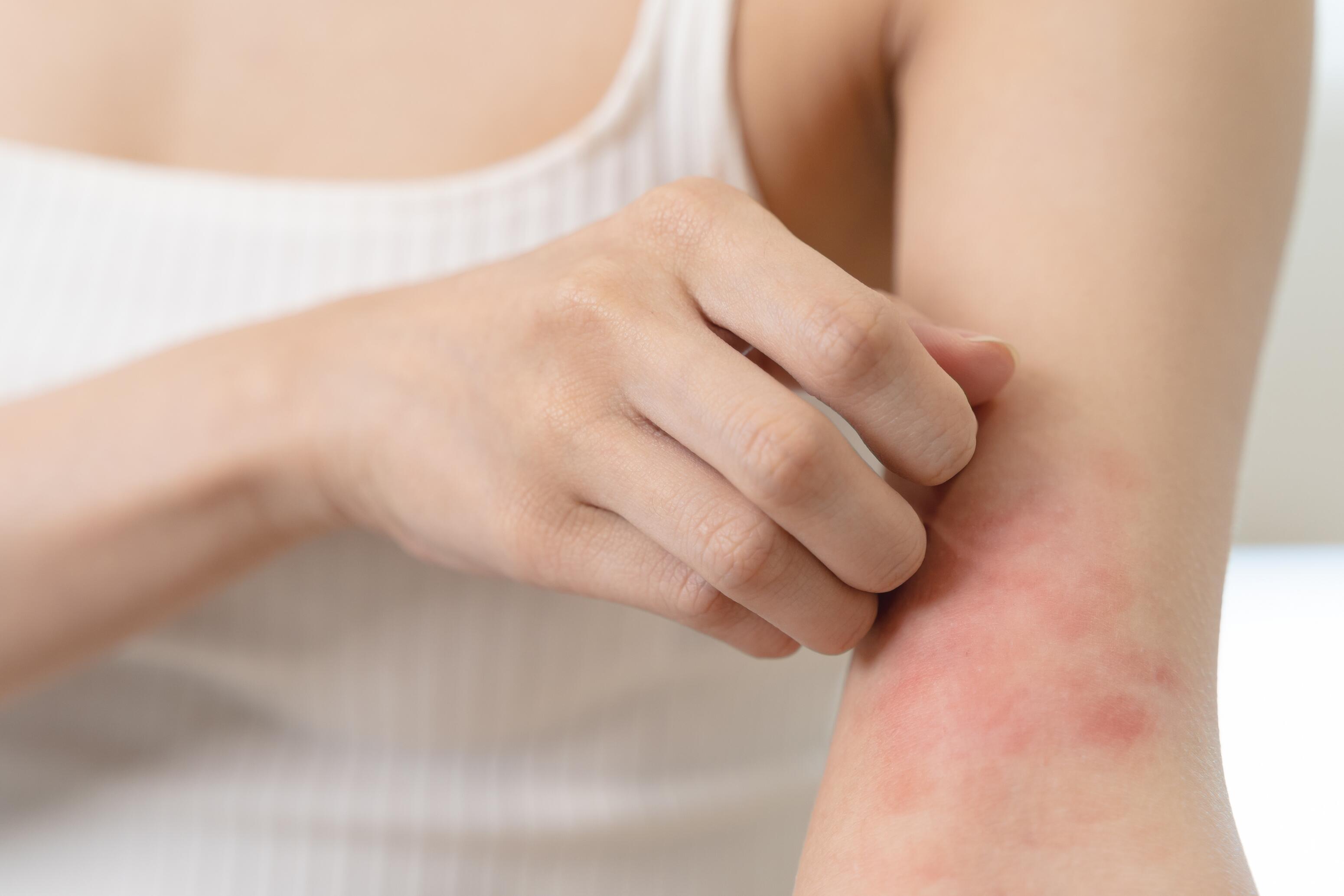 diagnostic eczéma